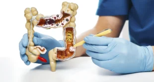 El aumento del cáncer colorrectal entre jóvenes: Una preocupante tendencia global