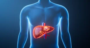 Síntomas y tratamiento nutricional del hígado graso