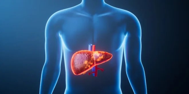 Síntomas y tratamiento nutricional del hígado graso