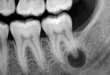 Radiografía dental mostrando un absceso en la raíz de una muela