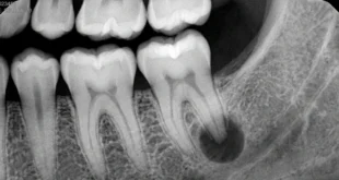 Radiografía dental mostrando un absceso en la raíz de una muela