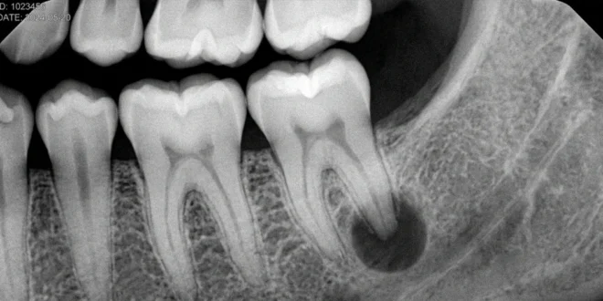 Radiografía dental mostrando un absceso en la raíz de una muela