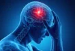 Ilustración médica de un cerebro humano indicando síntomas de ACV