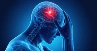 Ilustración médica de un cerebro humano indicando síntomas de ACV