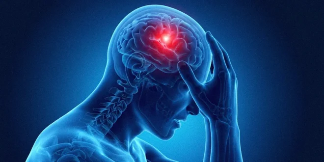 Ilustración médica de un cerebro humano indicando síntomas de ACV