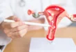 Origen del cáncer de ovario en las trompas de Falopio