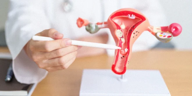Origen del cáncer de ovario en las trompas de Falopio